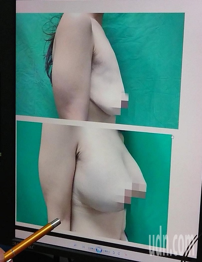 一名25歲網路直播主，為在產後恢復身材，3個月內瘦下24公斤，原本傲人D奶下垂成布袋奶（上圖），透過乳房拉提及隆乳手術補救，才回到螢幕前會網友。