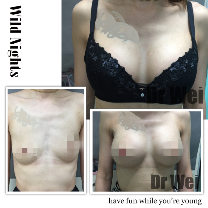 高雄水滴果凍隆乳案例A→D 高雄水滴果凍隆乳案例A→D