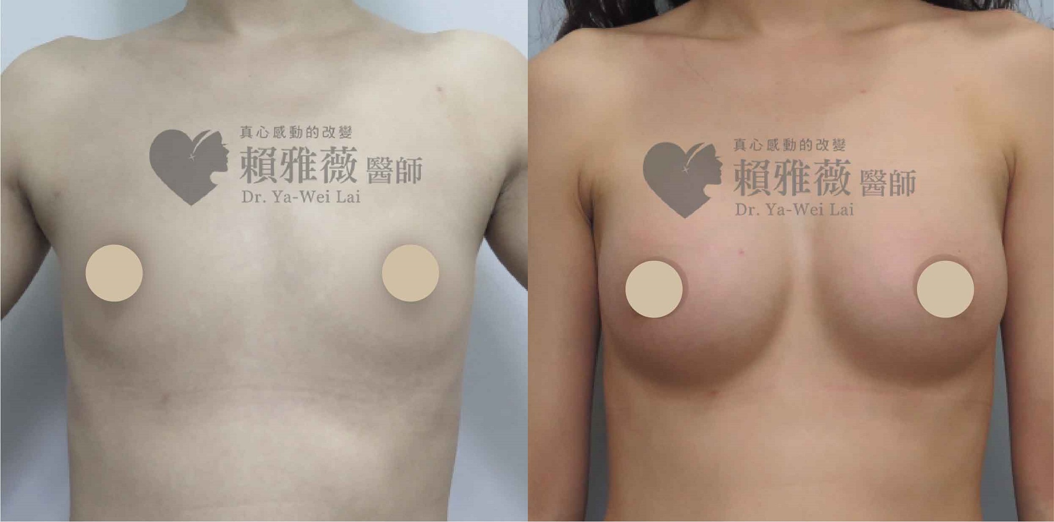 魔滴隆乳手術案例