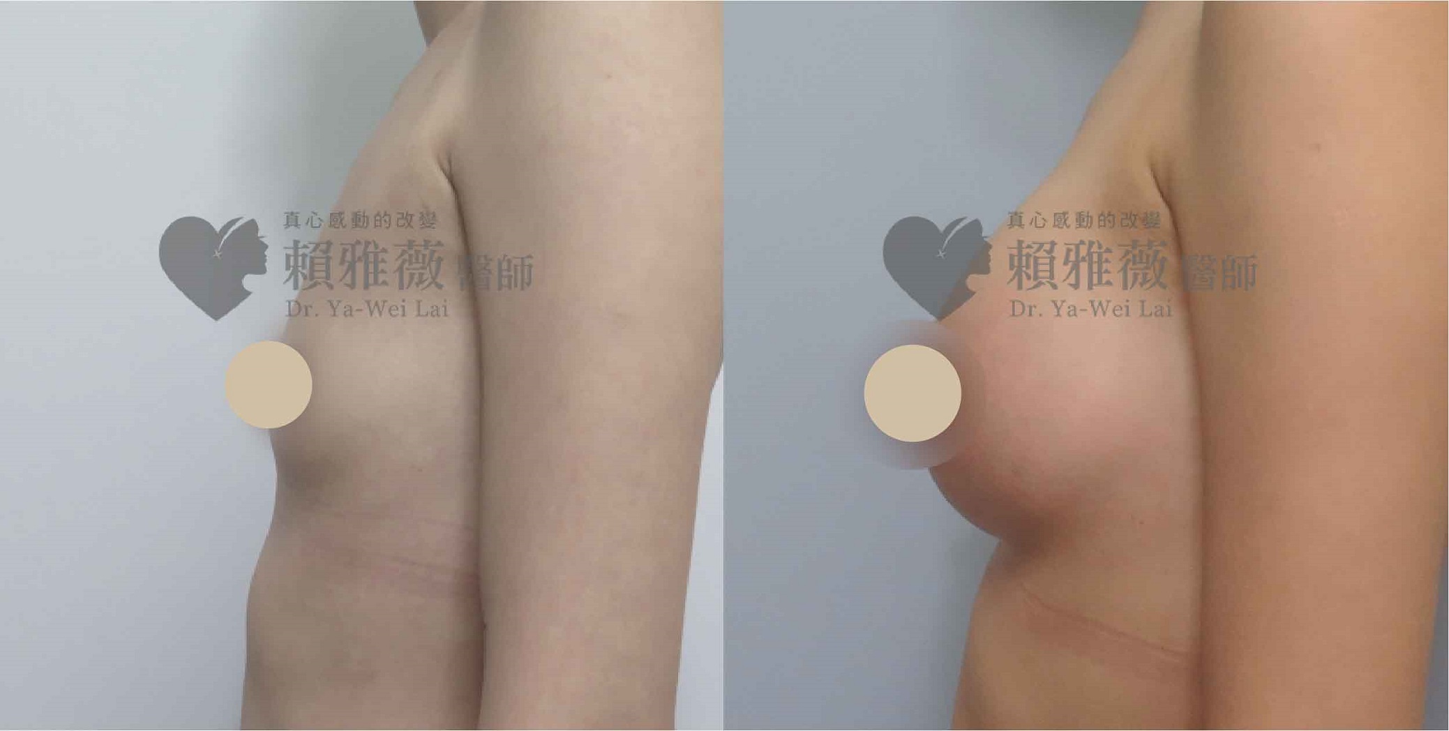 魔滴隆乳案例