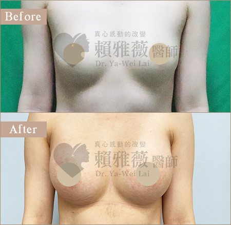 魔滴隆乳案例
