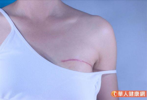 乳房整形手術後約7-14天傷口癒合後，建議就要開始塗抹疤痕凝膠